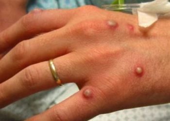 Bộ Y tế họp khẩn để bàn cách ứng phó dịch bệnh đậu mùa khỉ