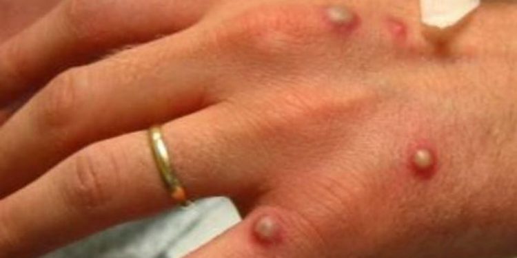 Bộ Y tế họp khẩn để bàn cách ứng phó dịch bệnh đậu mùa khỉ